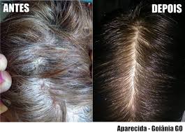 These patches normally appear on your elbows, knees, scalp and lower back, but can appear anywhere on your body. Psoriase Capilar Casa Di Cha