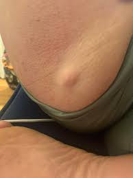 Ingrown hairs and hairs that have curled around and grown back into your skin instead of rising up from it. My Girlfriend Has Had This Large Bump On Near Her Ass Cheek For Over A Year We Tried To Pop It But It Won T Open It S A Little Red Is It An Ingrown