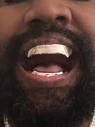 Kanye Wests titanium teeth are permanent, dentist claims | The Mercury