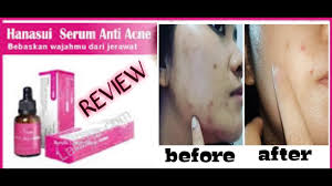 See full list on lippielust.com Hanasui Anti Acne Serum Review Serum Murah Berkualitas Youtube