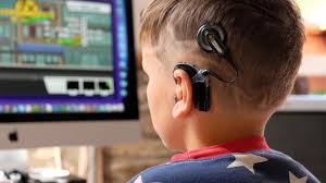 Image result for Cochlear Implant