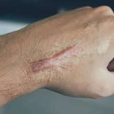 Image result for Skin Trauma