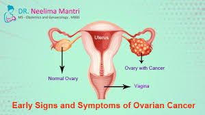 For this reason, it is important to be aware of the risk factors and contact a healthcare professional if symptoms appear. What Are The Early Signs And Symptoms Of Ovarian Cancer Dr Neelima Mantri