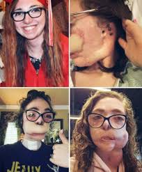 Venezuelan student survives drunk driving accident