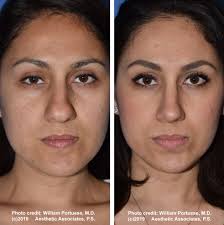 And a little word to you haters too. Bulbous Boxy Tip Before And After Photo Gallery