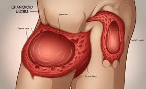 Image result for chancroid