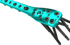 Proximal Humerus Locking Plate - Response Ortho