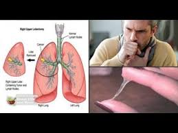 Lung cancer usually has no symptoms in its early stages. Lung Cancer Archives Canceris