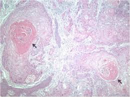 Keratin pearl synonyms, keratin pearl pronunciation, keratin pearl translation, english dictionary definition of keratin pearl. Investigation Of Keratinizing Squamous Cell Carcinoma Of The Tongue Using Terahertz Reflection Imaging Springerlink