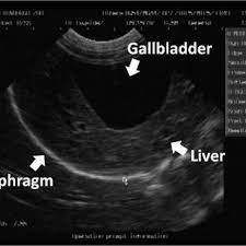 Normal Sonogram Ultrasound Image Of Normal Abdominal Organs In An Download Scientific Diagram
