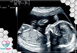 شكل الجنين في الشهر السادس بالسونار وأهم الفحوصات التي تتم في هذا الشهر مليون صحة
