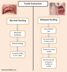 Pin On Tooth Extractions