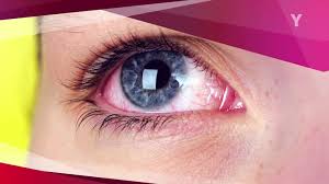 Check spelling or type a new query. Advanced Eye Care And Surgery Edukasi News