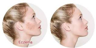 Best Narrowband UVB Light Therapy at Home |UVB Light Therapy