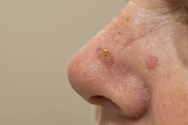 It certainly doesn't sound like a pleasant. Psoriasis Cancer Prevalence Is 4 7 New Research Shows