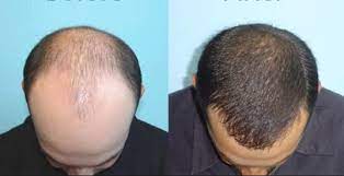 厨房 他在底下吸 2019成人在线免费视频 玉石h全文阅读 perda de cabelo queda de cabelo mulheres restauracao capilar