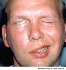 Generally, bell's palsy affects only one side of the face, but it can affect both sides. Advances In Facial Paralysis Enttoday