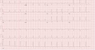 Doctors call this idiopathic pericarditis. Anticoagulation Management Issues In Pericarditis Induced Atrial Fibrillation American College Of Cardiology