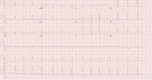 Doctors call this idiopathic pericarditis. Anticoagulation Management Issues In Pericarditis Induced Atrial Fibrillation American College Of Cardiology