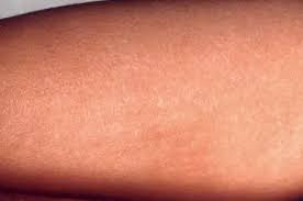 Image result for Scarlet Fever