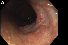 Image result for Proctitis