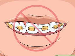 how to choose the color of your braces 14 steps with pictures