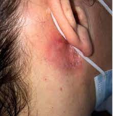 Hair dye allergies occur when the immune system responds to certain chemicals that are placed on the skin. Coronavirus Hairdressers Warned Over Post Covid Dye Allergy Risk Heraldscotland