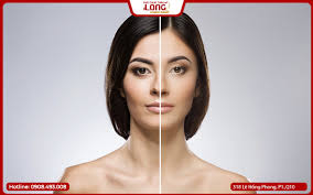 Thời gian hồi phục căng da mặt phẫu thuật