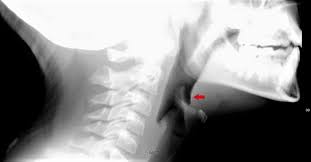 A 9 Year Old Girl With Sudden Onset Sore Throat After A Meal Journal Of Urgent Care Medicine