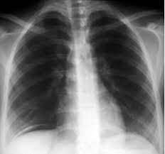Freie Subdiaphragmale Luft