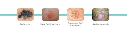 Skin cancer can present in a few different ways. Skin Cancer Diagnosis Treatment Associates In Dermatology