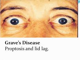 Lid lag is the static situation in which the upper eyelid is higher than normal with the globe in downgaze.1 it is most often a. Ppt Hyperthyroidism Powerpoint Presentation Free Download Id 356788