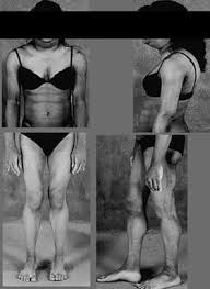 Image result for Lipodystrophy