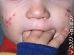 Image result for sores on the head in children