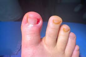 Image result for Toenail Removal