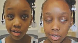 They may include muscle twitching, weakness, or total loss of the ability to move one, and in rare cases, both sides of the face. Bell Palsy As An Atypical Presenting Symptom Of Type 2 Diabetes Mellitus Consultant360