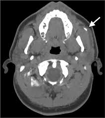 Image result for Sialoadenitis