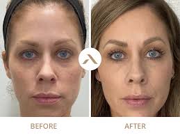 Temple Filler Treatment In Leicester