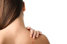 Cara cepat mengatasi jerawat punggung dengan produk erha acne back spray. Cara Mengatasi Jerawat Di Punggung Pure Laser Clinic Indonesia