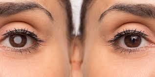 If you are noticing vision problems and have been told you have cataracts, it's likely your cataracts are bad enough to require surgery. Cataract Prevention Tips To Prevent Cataracts Naturally Irisvision