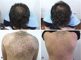 If it's tender on the bottom, you may have bent your finger backwards (another ligament injury). Alopecia Clinical Treatment Plastic Surgery Key