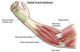 Cubital Tunnel Syndrome Test Precision Medical Group