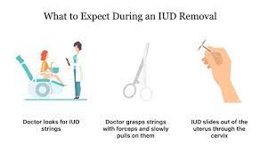 Copper iuds (intrauterine devices) are a form of birth control. Paragard Iud Removal What To Expect How To Prepare Side Effects