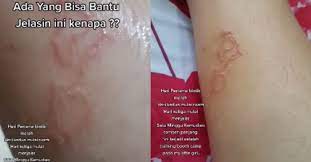 Maybe you would like to learn more about one of these? Video Ketahui Creeping Eruption Yang Disebabkan Oleh Lava Cacing Kerawit