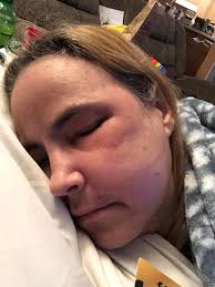 Prayers appreciated. Been struggling with allergies/ sinuses. Glands  swollen, difficult & painful to swallow.