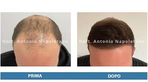 I poliambulatori medici tricomedit sono presenti a torino e alessandria da oltre 40. Dottor Antonio Napoletano La Nuova Frontiera Della Terapia Per Dare Risposta Alla Calvizie La Repubblica