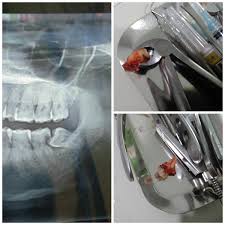 Ternyata dokternya ada jam 5 sore. Operasi Gigi Bungsu Dengan Biaya Bpjs Kesehatan Me And Around