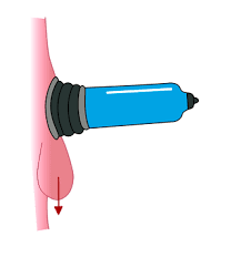 Notably bathmate pumps work best when used with water, however for those that don't have the opportunity or privacy to use the pumps in the. How To Use Hydromax Penis Pump Step By Step Guide Bathmate