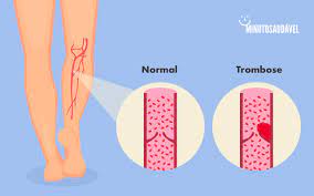 A trombose é a formação de um coágulo sanguíneo em uma veia, geralmente das pernas. Trombose Dicas Valiosas Para Prevenir A Doenca Cidadeverde Com