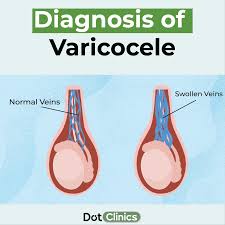 Image result for Varicocele